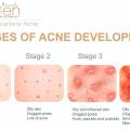 Five key benefits of having acne treated with the NeoGen plasma method.